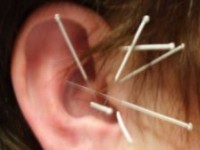 Neurodegenerative Erkrankungen wie MS und ALS sowie Neuralgien erfolgreich mit Ohrakupunktur behandeln